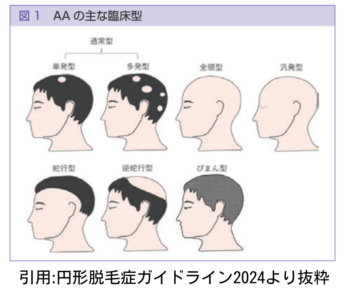 円形脱毛症の種類の画像