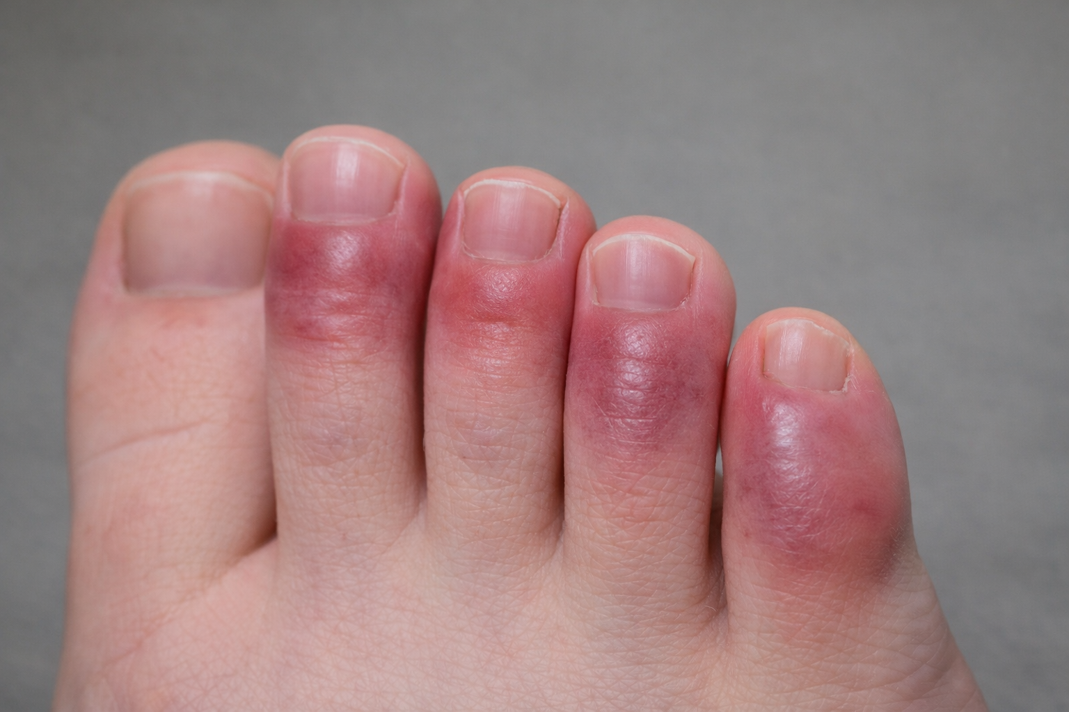 しもやけのイメージ図