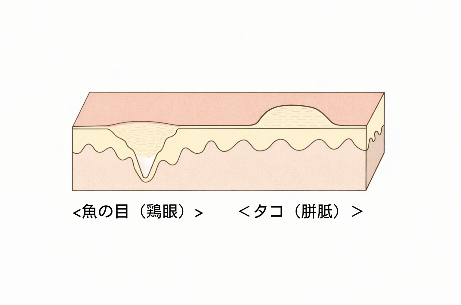 胼胝と鶏眼の違い
